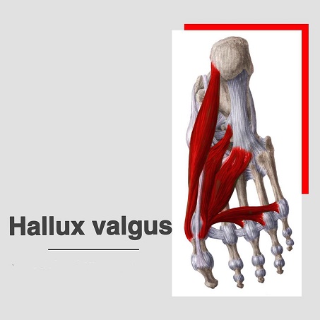 Hallux valgus